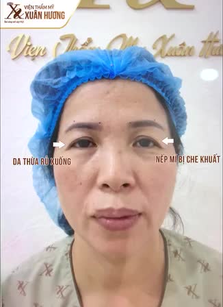 XÓA DẤU VẾT THỜI GIAN NƠI ĐÔI MẮT - TRẺ RA TỚI 10 TUỔI NHỜ NÂNG CUNG MÀY TẠI VTM XUÂN HƯƠNG