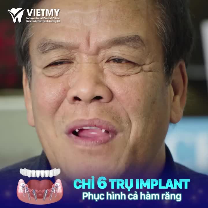 6 TRỤ IMPLANT, HỒI SINH RĂNG TOÀN HÀM - "GIỜ TÔI ĂN ĐẦU GÀ NHAI RAU RÁU ĐƯỢC"