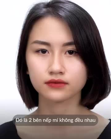 15P Loại bỏ tình trạng mí lệch, nhiều nếp mí Chọn Mắt TC