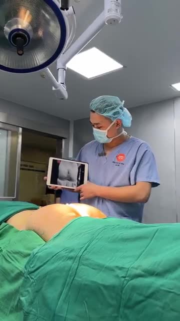 KẾT QUẢ CA CẤY MỠ V3 RẤT ĐẸP