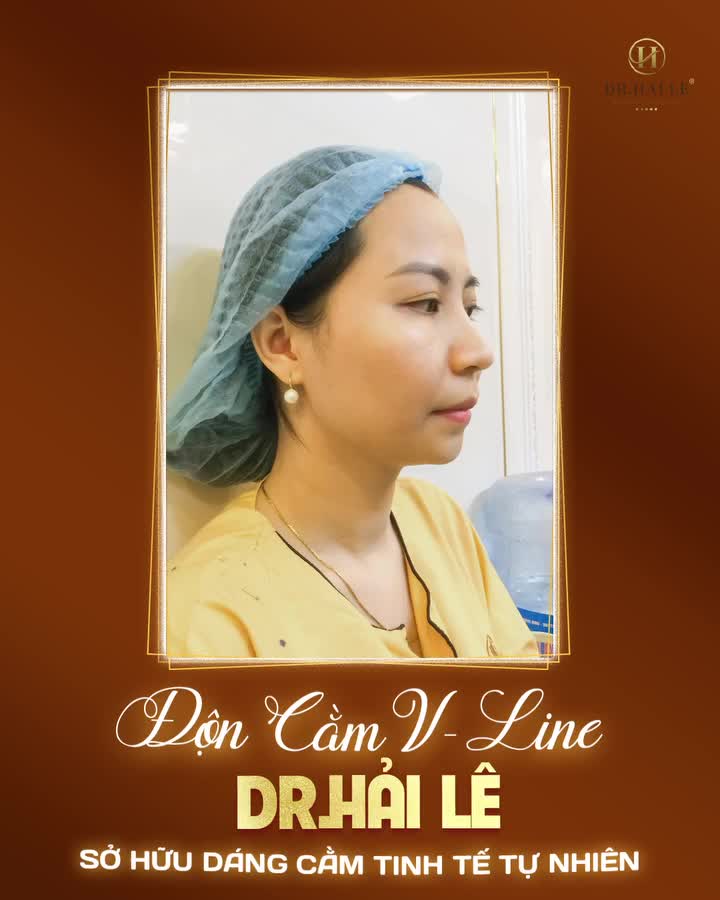 Còn chần chừ gì nữa, Độn cằm- V line ngay hôm nay tại Dr.Hải Lê đi nào các chị em ơi!