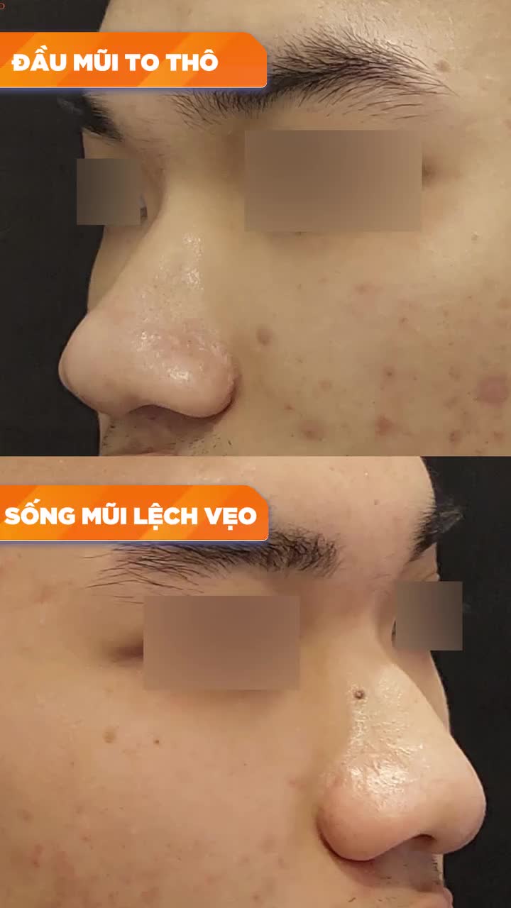 SỬA SẸO MŨI MÔI CHO BẠN KHÁCH HÀNG 20 TUỔI!