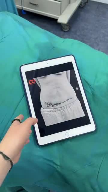 HÚT MỠ BỤNG, LƯNG, HÔNG BẰNG CÔNG NGHỆ VASER LIPO.