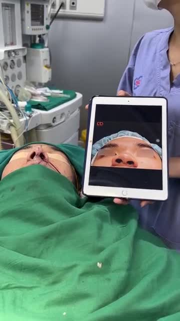 ĐÃ CÓ KẾT QUẢ CA NÂNG MŨI SỤN SƯỜN + SỬA SẸO MÔI CHO BẠN TRAI.