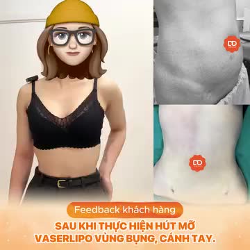 Chiêm ngưỡng kết quả "Body nóng bỏng" sau khi thực hiện dịch vụ hút mỡ Vaserlipo vùng bụng và cánh tay.