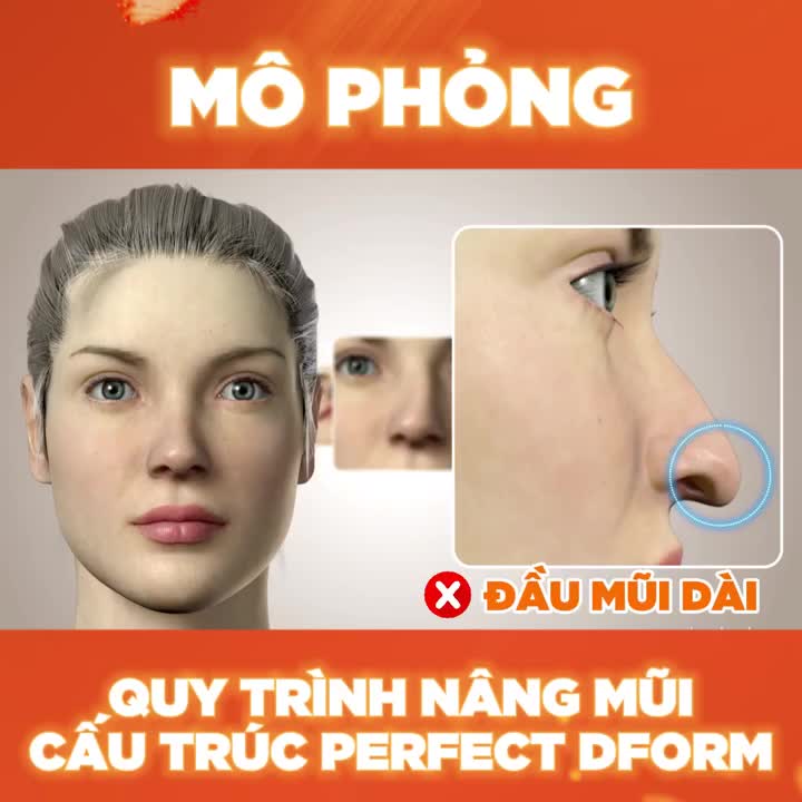 MÔ PHỎNG QUY TRÌNH NÂNG MŨI CẤU TRÚC PERFECT DFORM