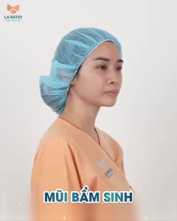 NÂNG MŨI CẤU TRÚC MEGA S - THAY SẮC ĐỔI VẬN - MŨI ĐẸP NHANH KHÔNG CẦN BĂNG NẸP