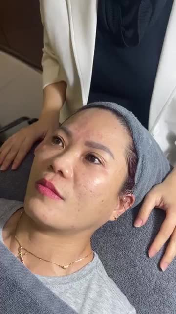 TIÊM MESO TRỊ MỤN thay da em bé LÁNG MỊN cho quý cô U50