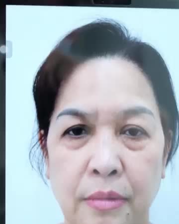 Kết quả sau 1 tháng thực hiện combo: Nâng cung mày, cắt cơ cau mày, cắt và trẻ hóa mí dưới.