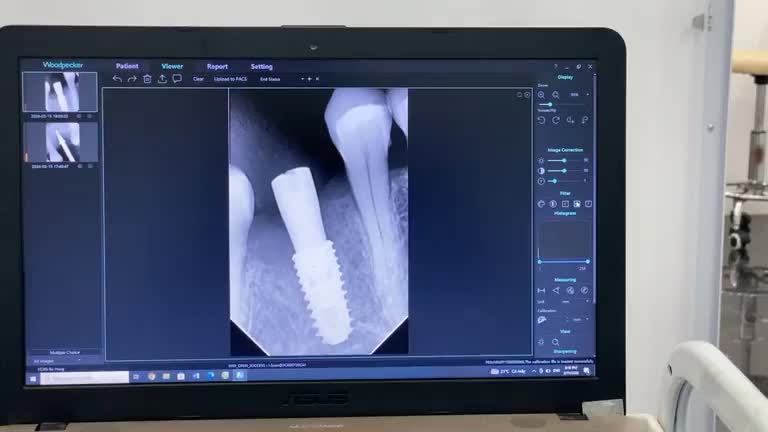 Case Implant nâng xoang tiếp theo trong ngày