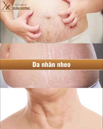 Giải pháp cho chị em bị rạn da đây rồi, Vinno Effect phục hồi và tái sinh làn da, mờ rạn siêu hiệu quả chỉ với liệu trình ngắn
