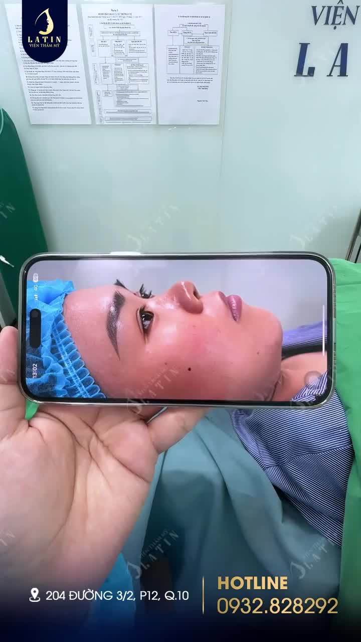 Kết quả nâng mũi cấu trúc sụn tai, sóng surgiform cho em gái H.T