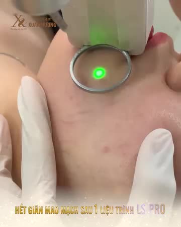 "Makeup cũng không che hết được giãn mao mạch nên mình rất tự ti"