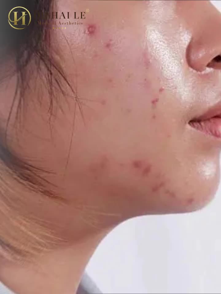 Đâu là giải pháp cho các vấn đề về mụn