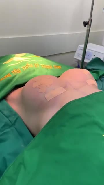 Ngực teo lép, sa trễ nhẹ sau sinh
