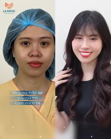 NÂNG MŨI KHÔNG BĂNG NẸP - XU HƯỚNG THẨM MỸ 2024