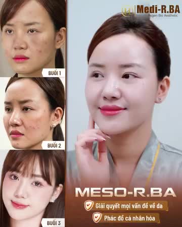 Medi-R.BA được biết đến là tổ hợp công nghệ tái tạo tái sinh làn da đa lớp 360 lần đầu tiên được ứng dụng trong điều trị các vấn đề về da ở Việt Nam.