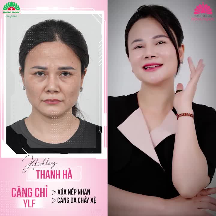 TRẺ HÓA XÓA NHĂN NGAY HÔM NAY CÙNG CĂNG CHỈ YOUNGER LIFTING FIBER