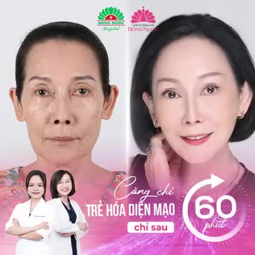 NÂNG ĐỠ GƯƠNG MẶT CHẢY XỆ GIÀ NUA VỚI CĂNG CHỈ YLF