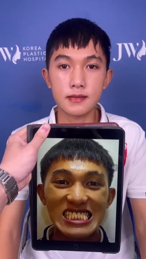 CHIÊM NGƯỠNG vẻ đẹp như HOT BOY của chàng trai GEN Z sau PHẪU THUẬT HÀM GIẢM ngay 15 Triệu Phẫu thuật Hàm tại đây: https://benhvienjw.com/uudaifb