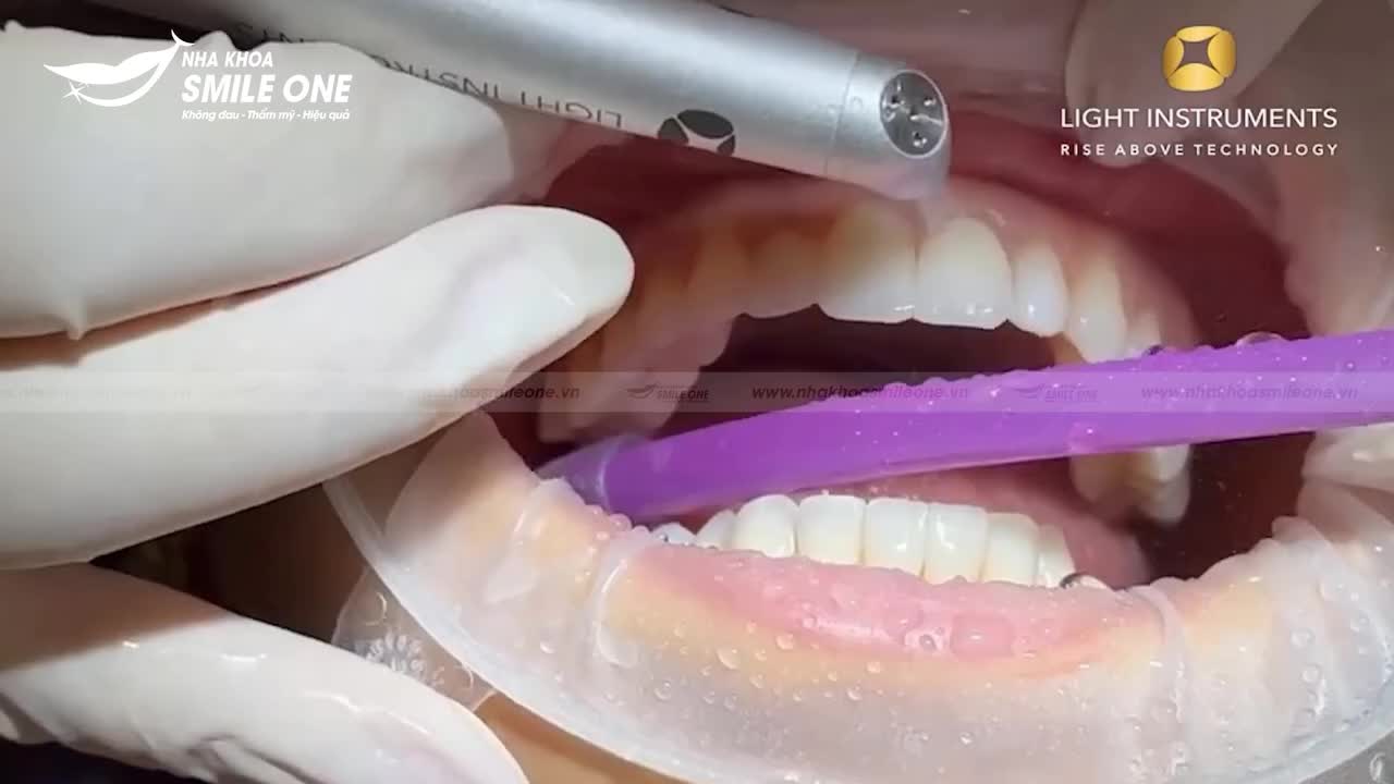 Ứng dụng Laser LiteTouch Er:YAG mô cứng mô mềm trong thăm khám và điều trị cho khách hàng tại nha khoa Smile One.