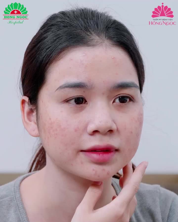 RŨ BỎ ''RÀO CẢN'' MANG TÊN MỤN