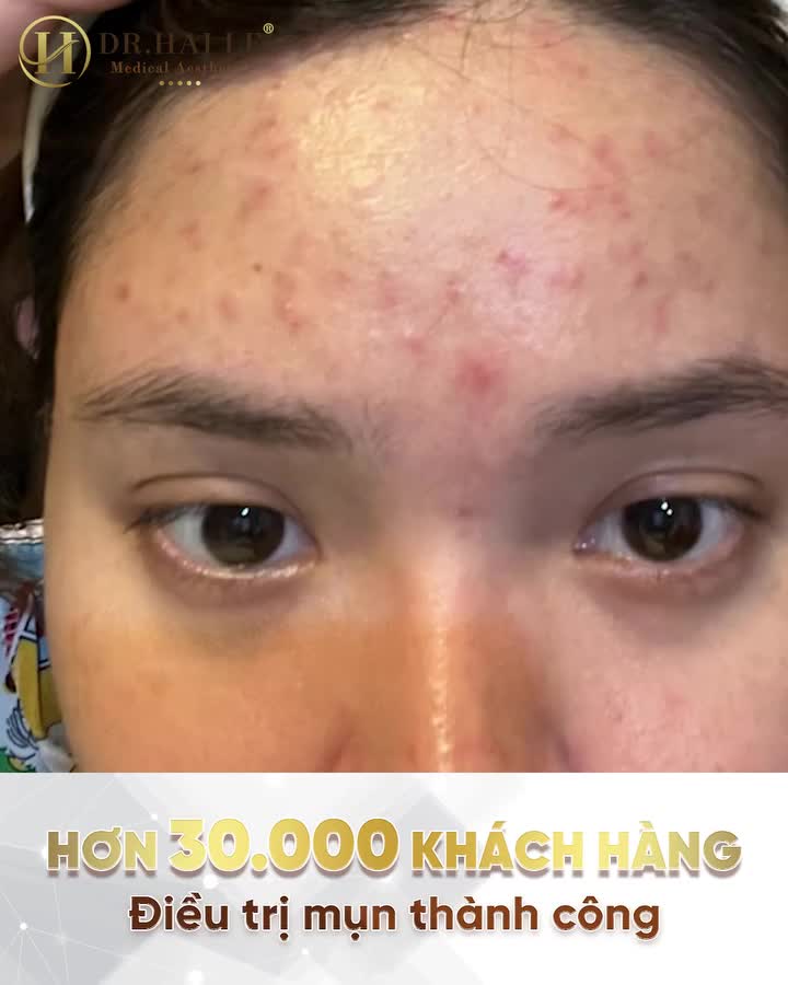 Khách hàng trị mụn tại Dr Hải Lê