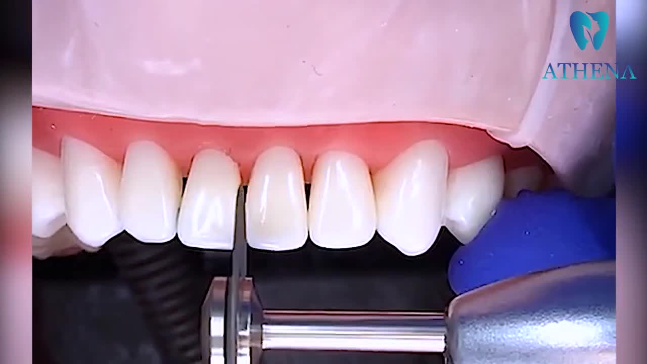 Mài Kẽ Răng Để Niềng Và Những Lưu Ý Không Nên Bỏ Qua