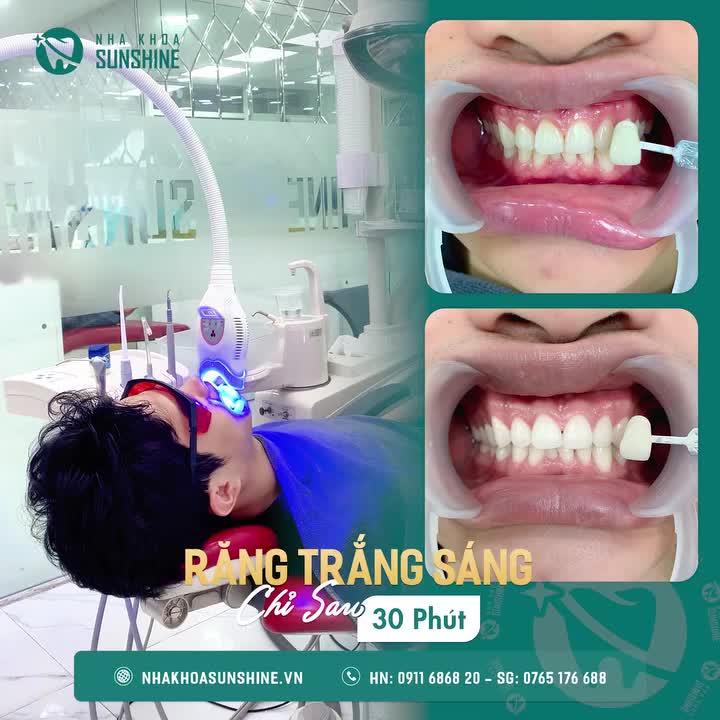 TẨY TRẮNG RĂNG - BẬT TÔNG NGAY LẦN ĐẦU TRẢI NGHIỆM