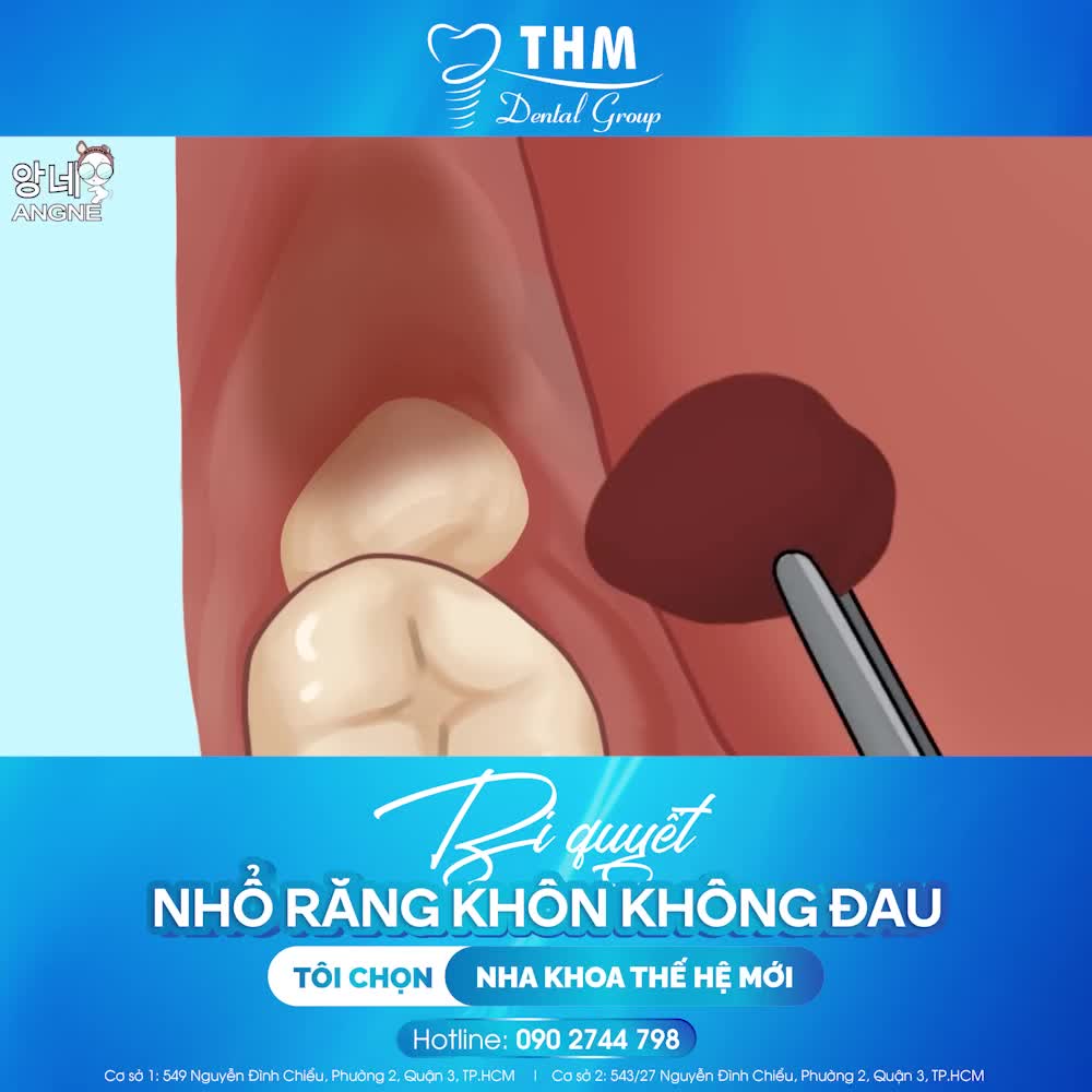 BÍ QUYẾT NHỔ RĂNG KHÔN KHÔNG ĐAU - TÔI CHỌN NHA KHOA THẾ HỆ MỚI