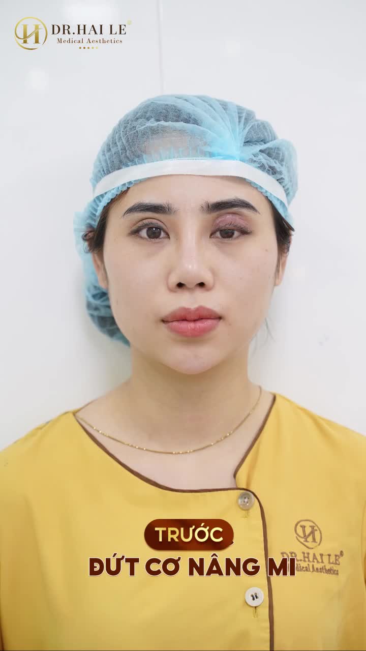 SỬA MÍ MẮT HỎNG, TÁI SINH ĐÔI MẮT