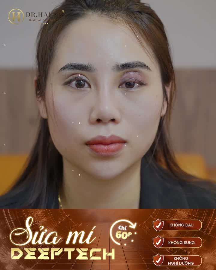 CÂN CHỈNH MÍ LỖI HỎNG, ĐẸP NGAY SAU 60 PHÚT