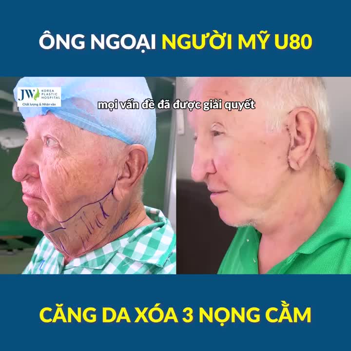 Ông nội người Mỹ U80 CĂNG DA CỔ xoá NỌNG CẰM 80-year-old Grandpa gets rid of Turkey Neck by Neck Lift