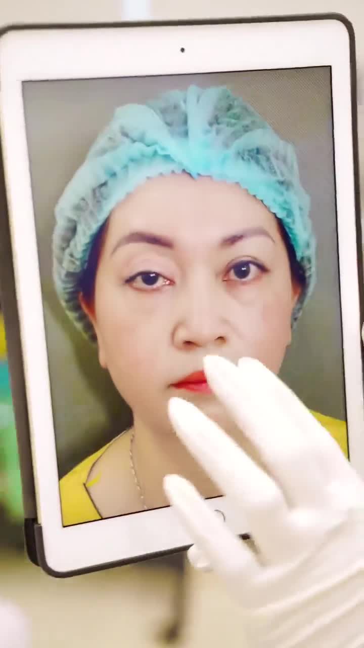 Sửa mí Deep Tech Dr.Hải Lê - "Giải cứu" đôi mắt lỗi nặng của vị khách hàng!