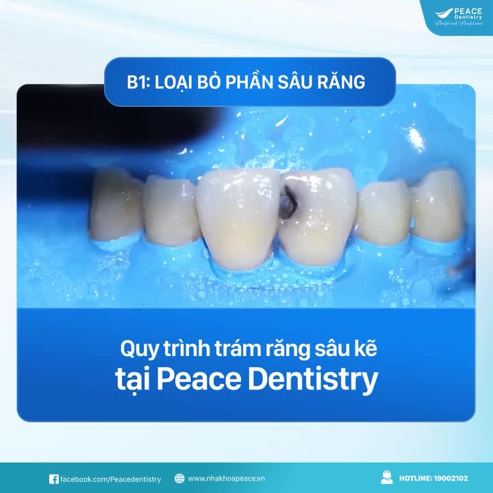 TRÁM RĂNG SÂU KẼ HIỆU QUẢ, NHANH CHÓNG, THẨM MỸ TỰ NHIÊN