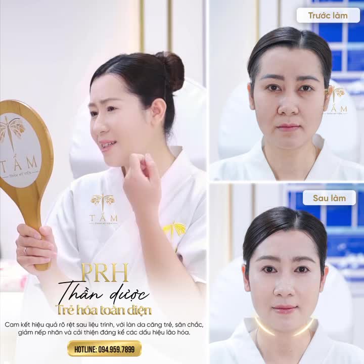 Feedback của khách hàng ngay sau khi làm trẻ hoá cấu trúc PRH