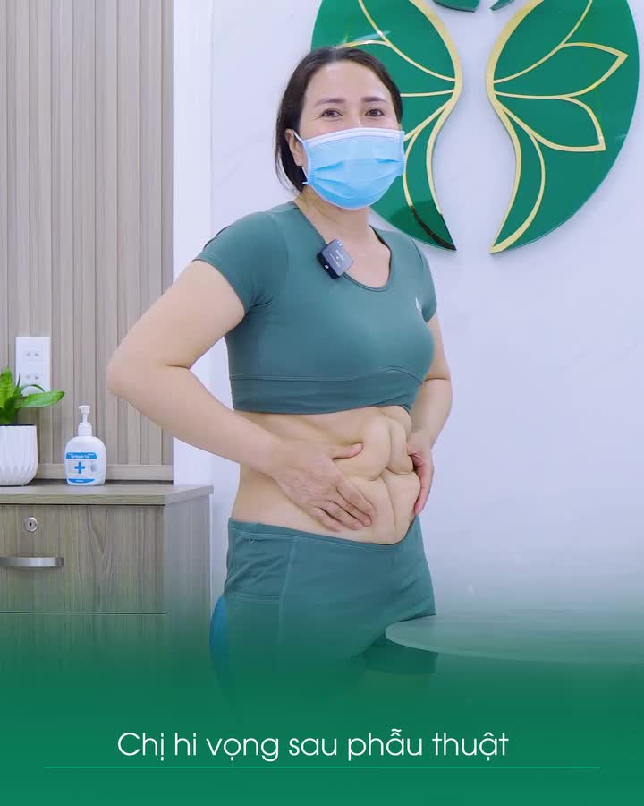 Nỗi ám ảnh "bụng hỏng" của chị khách hàng đã từng trải qua phẫu thuật tạo hình thành bụng 3 năm trước!