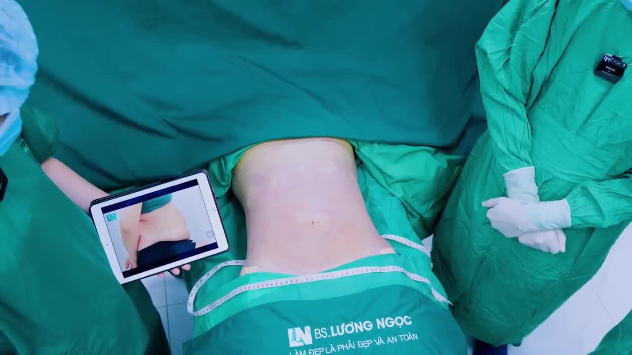 Không cần phẫu thuật, không đau đớn, chỉ sau 1 giờ thực hiện hút mỡ bụng siết eo ekip Bác sĩ Lương Ngọc, chị Linh đã có được vòng eo thon gọn thắt đáy mơ ước.