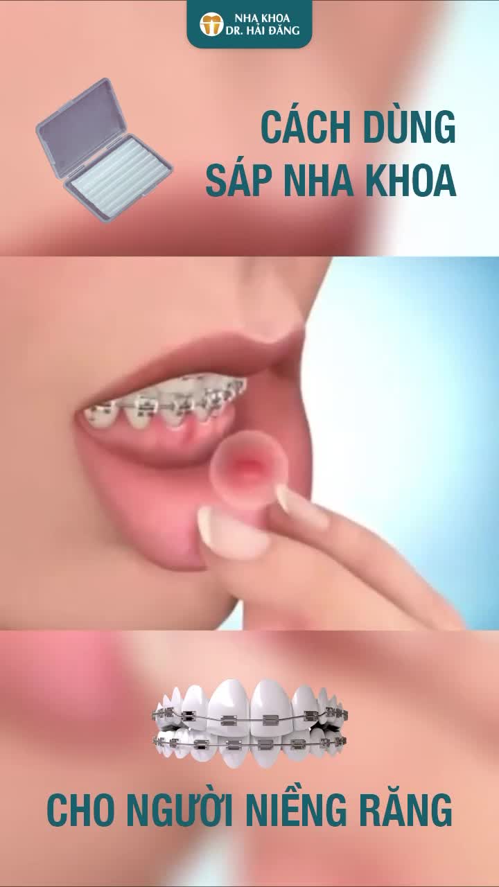 HƯỚNG DẪN CÁCH DÙNG SÁP NHA KHOA KHI NIỀNG RĂNG