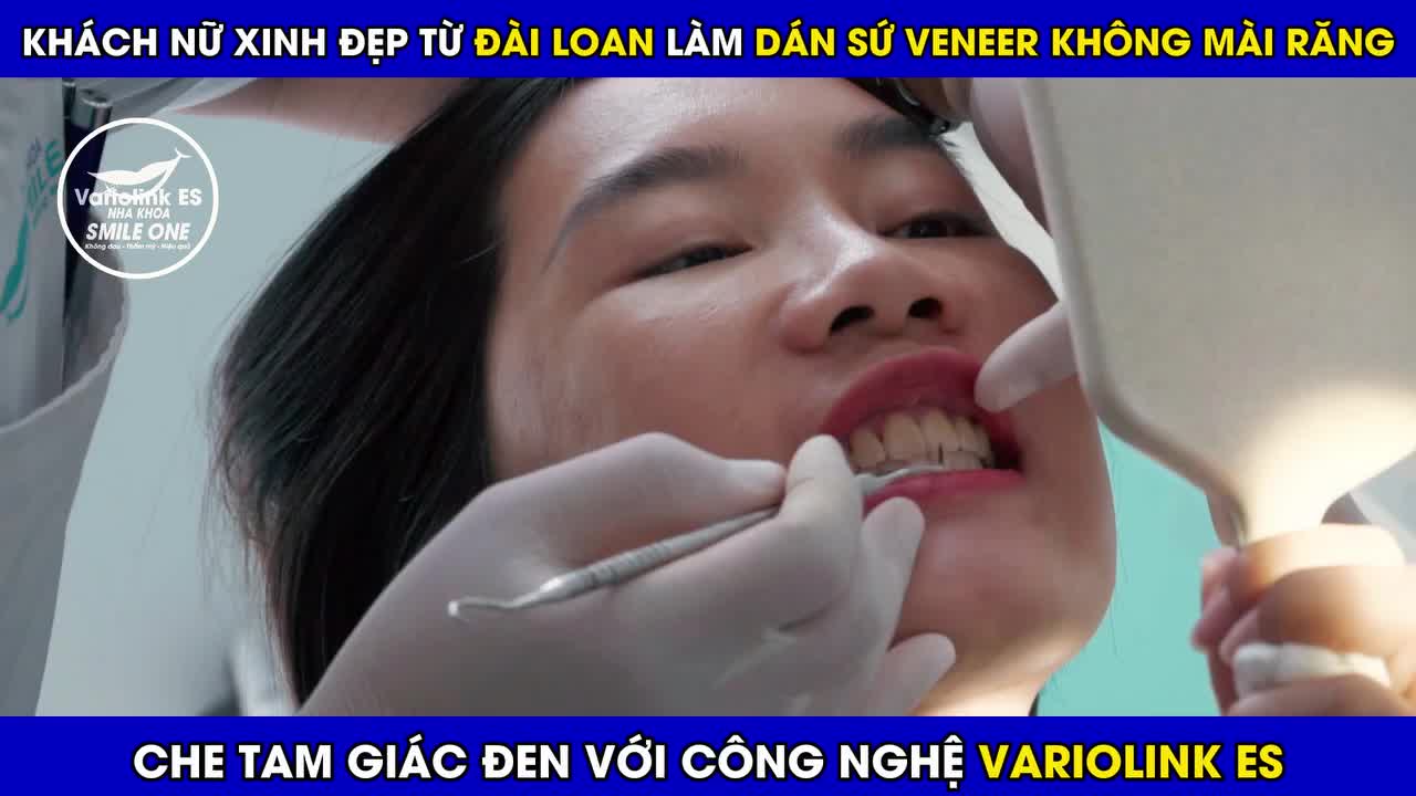 CÔ GÁI ĐÀI LOAN DÁN SỨ VENEER KHÔNG MÀI RĂNG CHE TAM GIÁC ĐEN