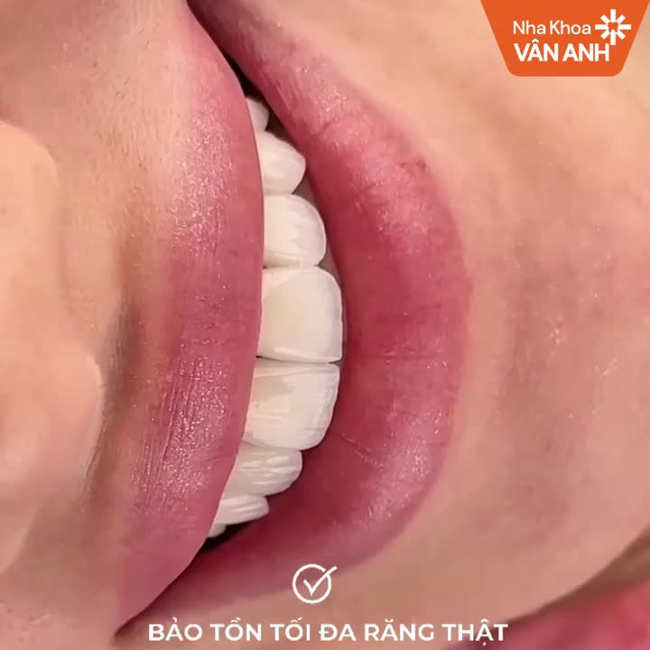 TẠI NHA KHOA VÂN ANH - R.Ă.NG XẤU NẶNG ĐẾN ĐÂU CŨNG "ĐẸP NGAY" VỚI BỌC RĂNG SỨ CHUẨN ĐỨC