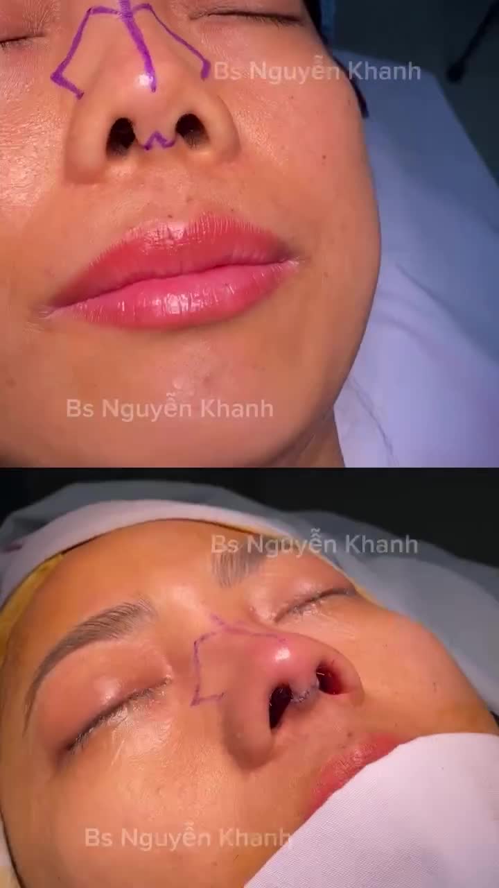 Nhìn vào hình ảnh sau phẫu thuật, có thể thấy rõ sự khác biệt.