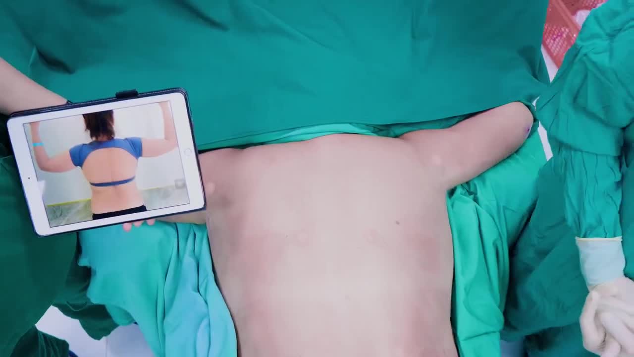 Chỉ sau 70 phút, chúng tôi đã giúp chị xử lý sạch mỡ thừa ở phần “tay – lưng – nách” và kết quả thật sự khiến cả Ekip rất hài lòng.