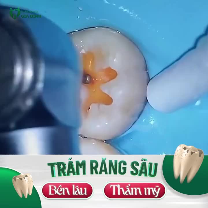 TRÁM RĂNG SÂU - BỀN LÂU THẨM MỸ