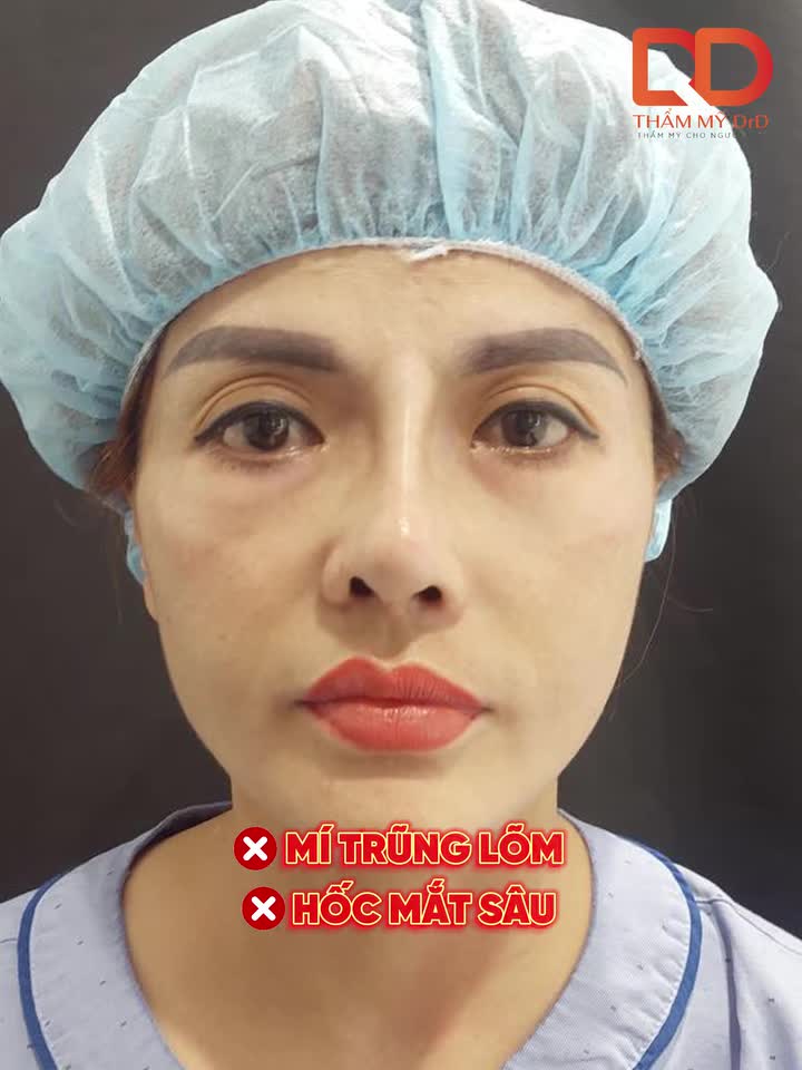 VẼ LẠI ĐƯỜNG MI - XOÁ ĐI TRŨNG LÕM