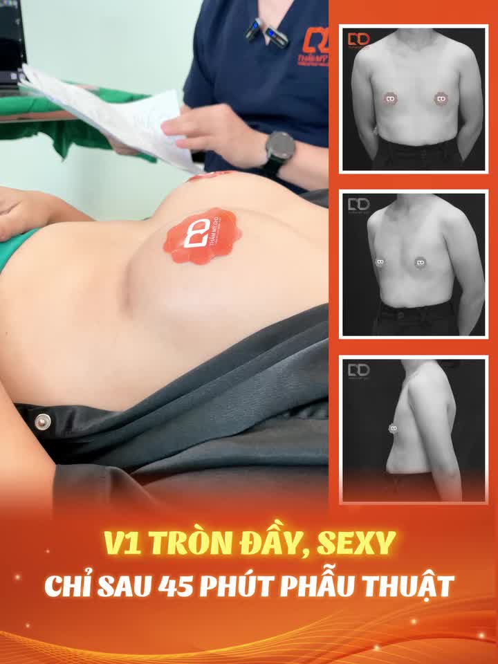 ĐỪNG ĐI NÂNG V1 - VÌ NÂNG XONG SẼ BỊ "VUI" QUÁ!