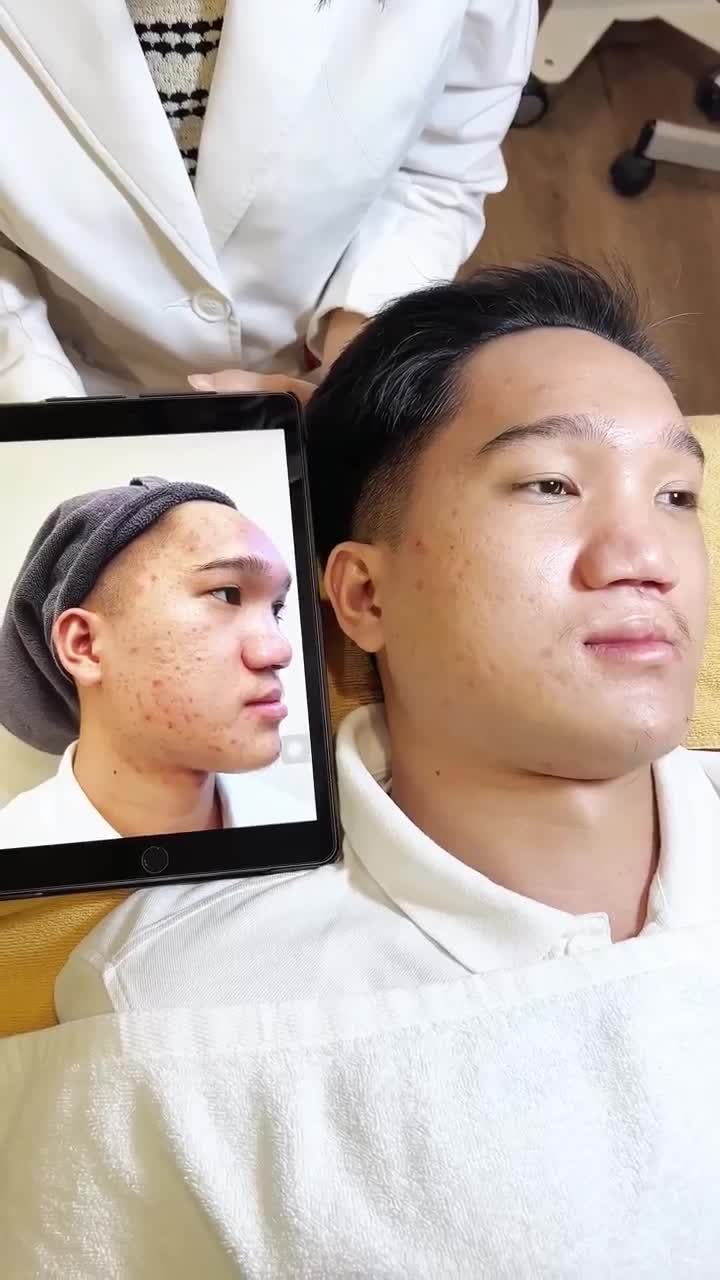 CẬN CẢNH: Làn da nam sinh GenZ THAY ĐỔI XUẤT SẮC sau quá trình ĐIỀU TRỊ MỤN + SẸO RỖ tại JW