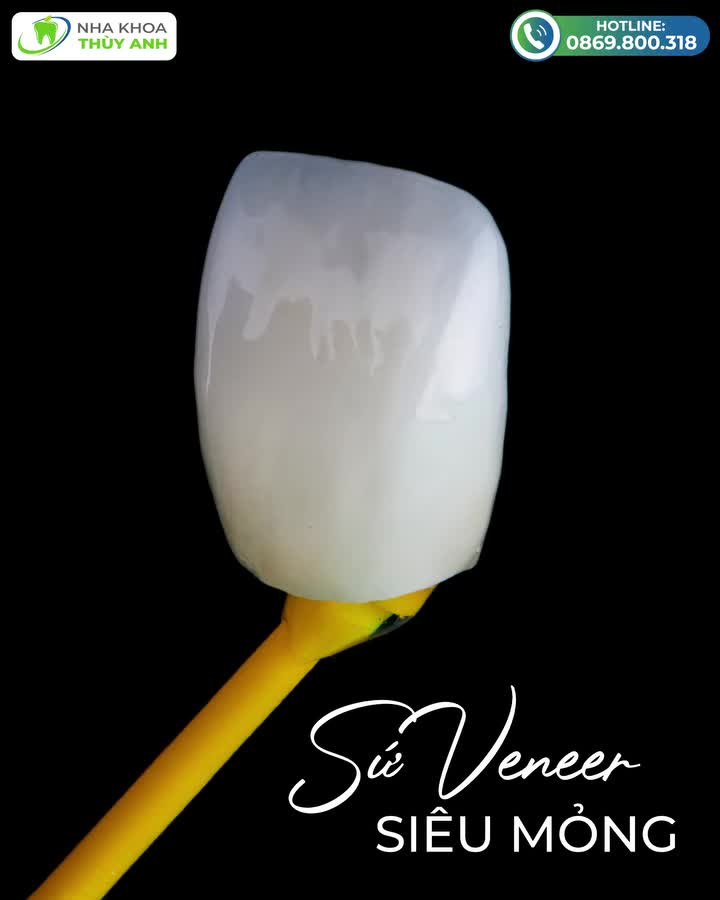 RĂNG SỨ VENEER - THỜI ĐẠI THỜI THƯỢNG