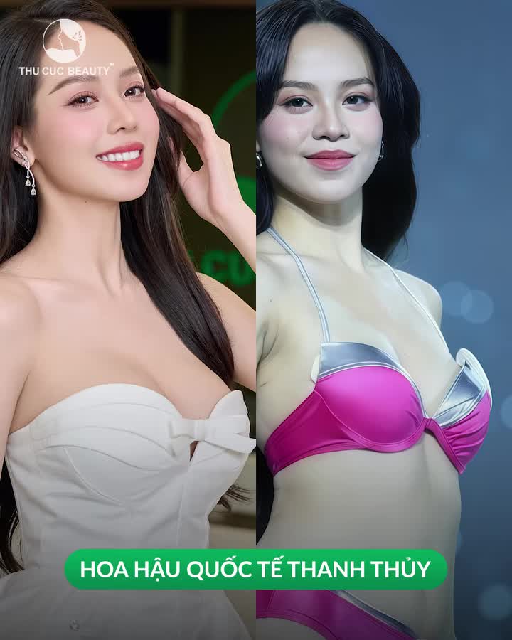 Không còn tự ti vì V1 teo lép. Quyết tâm thay đổi cùng Ngực TC 39.9TR