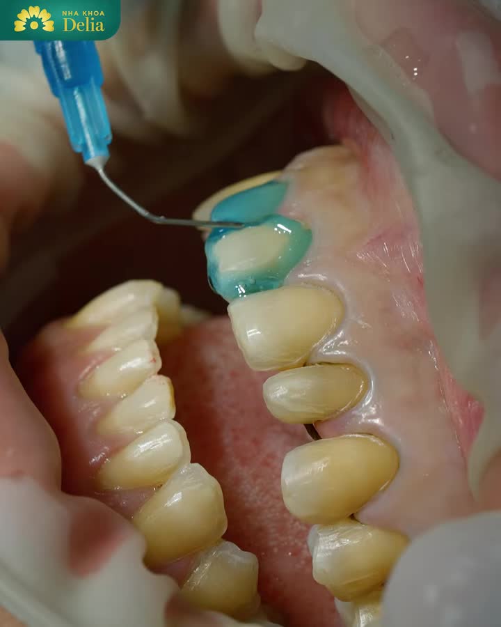 LÀM RĂNG SỨ KHÔNG MÀI NHỎ, KHẮC PHỤC Ố VÀNG